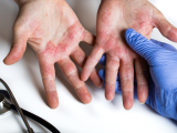 Uso efectivo de dupilumab para la dermatitis atópica