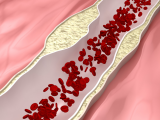 Altos niveles de lipoproteína(a) impulsan la enfermedad coronaria