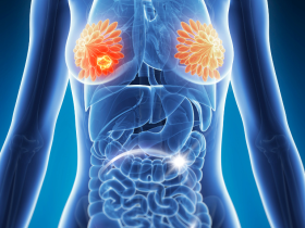 Microbioma intestinal influye en la farmacoterapia del cáncer de mama