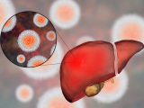 ARNi como tratamiento innovador para la hepatitis B crónica