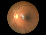Agente hipoglucemiante capaz de frenar la retinopatía diabética