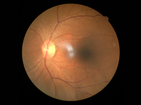 Agente hipoglucemiante capaz de frenar la retinopatía diabética