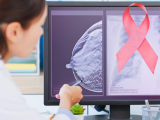 Optimización del tratamiento del cáncer de mama triple negativo