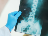 Zoledronato para prevenir fracturas en mujeres posmenopáusicas