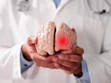 Deterioro cognitivo tras un ataque isquémico transitorio