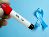 Importancia del examen del PSA antes de los 70 años en cáncer de próstata