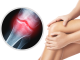 Potencial de la metformina para tratar la osteoartritis de rodilla