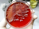 Avances en el manejo de la bacteriemia por S. aureus