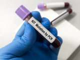 Importancia del monitoreo molecular en la leucemia mieloide aguda