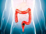 Beneficios del ejercicio en la recuperación del cáncer de colon