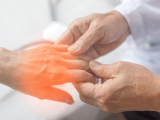 dolor neuropático, neuropatía periférica, neuropatía diabética, nervios periféricos, neuropatía periférica dependiente de la longitud, neuropatía distal simétrica, neuropatía periférica inducida por quimioterapia