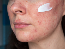 rosácea, tratamientos tópicos para rosácea, ivermectina tópica, peróxido de benzoílo encapsulado, metronidazol tópico, minociclina, ácido azelaico