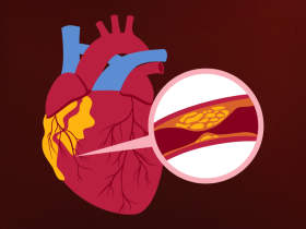 dislipidemia, tratamiento de la dislipidemia, estatinas, rosuvastatina, atorvastatina, ezetimiba, tratamiento hipolipemiante, nueva guía de dislipidemia, aterosclerosis, enfermedad cardiovascular aterosclerótica