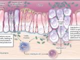 Cáncer colorrectal, por culpa de la inflamación