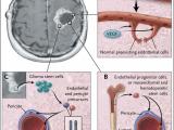La angiogénesis en los tumores cerebrales