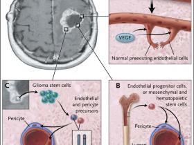 La angiogénesis en los tumores cerebrales