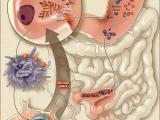 La ilustre historia de la anemia perniciosa