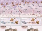 Melanoma: un asunto de piel y edad