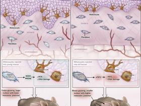 Melanoma: un asunto de piel y edad