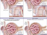 Diabetes y nefroprotección en la enfermedad renal