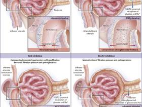 Diabetes y nefroprotección en la enfermedad renal