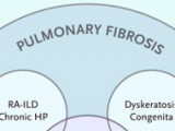 Los secretos de la fibrosis pulmonar idiopática