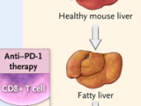 Carcinoma hepatocelular: orígenes y resultados