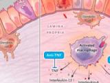Terapia oral selectiva para la enfermedad de Crohn