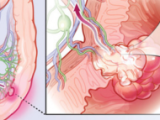 Anticipándose al cáncer colorrectal