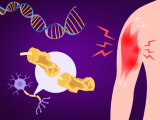 Potencial tratamiento para la esclerosis lateral amiotrófica genética