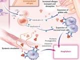 anafilaxia, anafilaxia alimentaria, anafilaxia severa, alérgenos alimentarios, anafilaxia inducida por alimentos