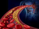 Galectina-1 previene el desarrollo de aterosclerosis y aneurisma aórtico 