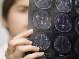 La teoría priónica del Parkinson