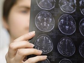 La teoría priónica del Parkinson