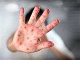 Monkeypox: ecos de la viruela