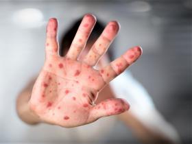Monkeypox: ecos de la viruela