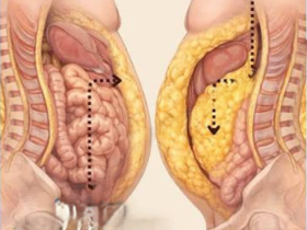 grasa abdominal, tejido adiposo, grasa visceral, adipositos, lípidos